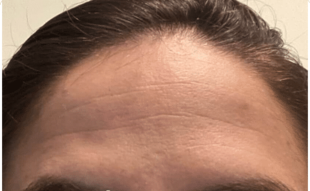 Forehead, before