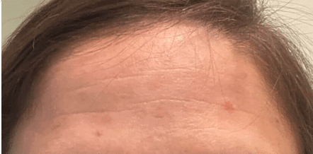 Forehead, after