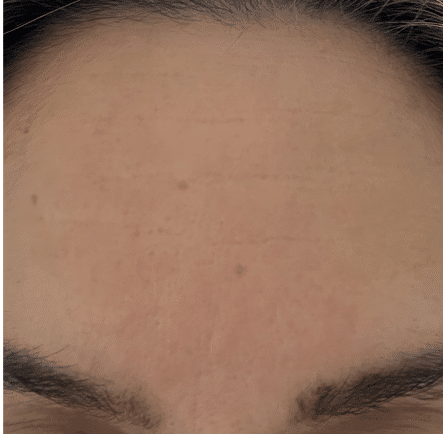 Forehead, after one year