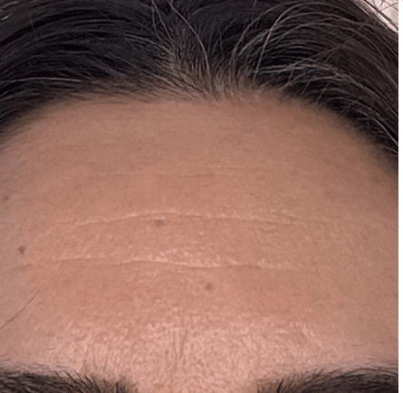 Forehead, before
