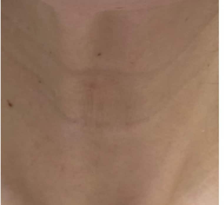 Neck, after