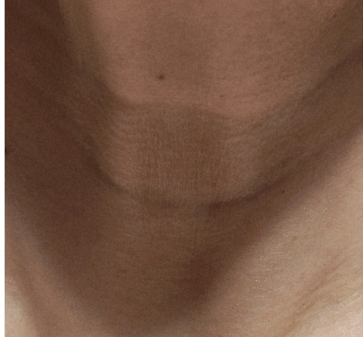Neck, before
